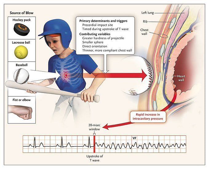 What Is Commotio Cordis? Damar Hamlin Injury Name Speculated