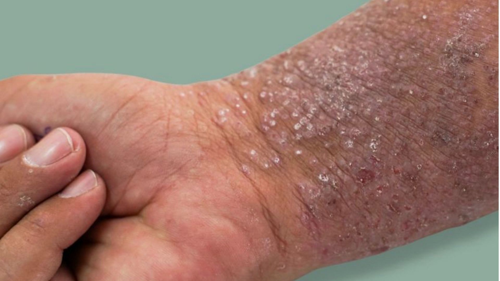 Eczema is a type of skin rash that cause flare-ups. (Photo via Instagram/drsandyskotnicki)