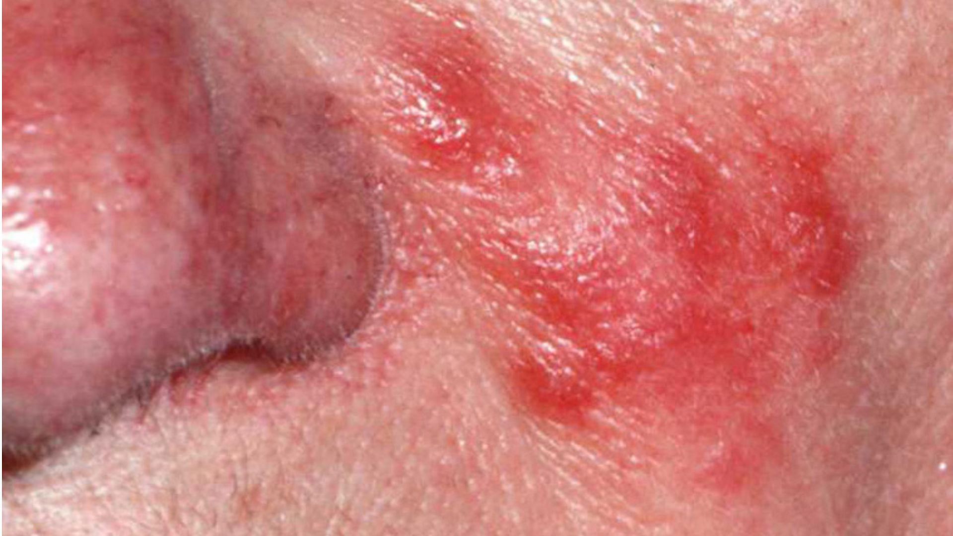 Rosacea is often mistaken for acne. (Image via Flickr)