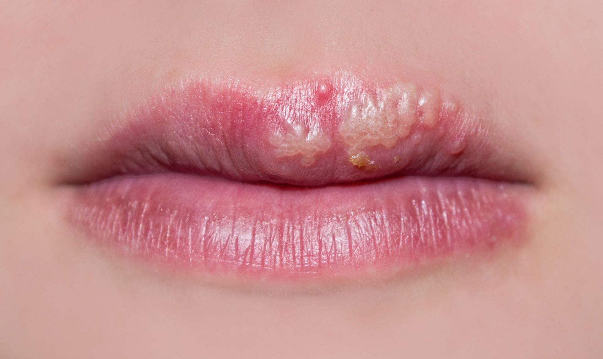 Want to get rid of cold sores? Try these natural remedies for cold sores. (Image via MeMD.com)
