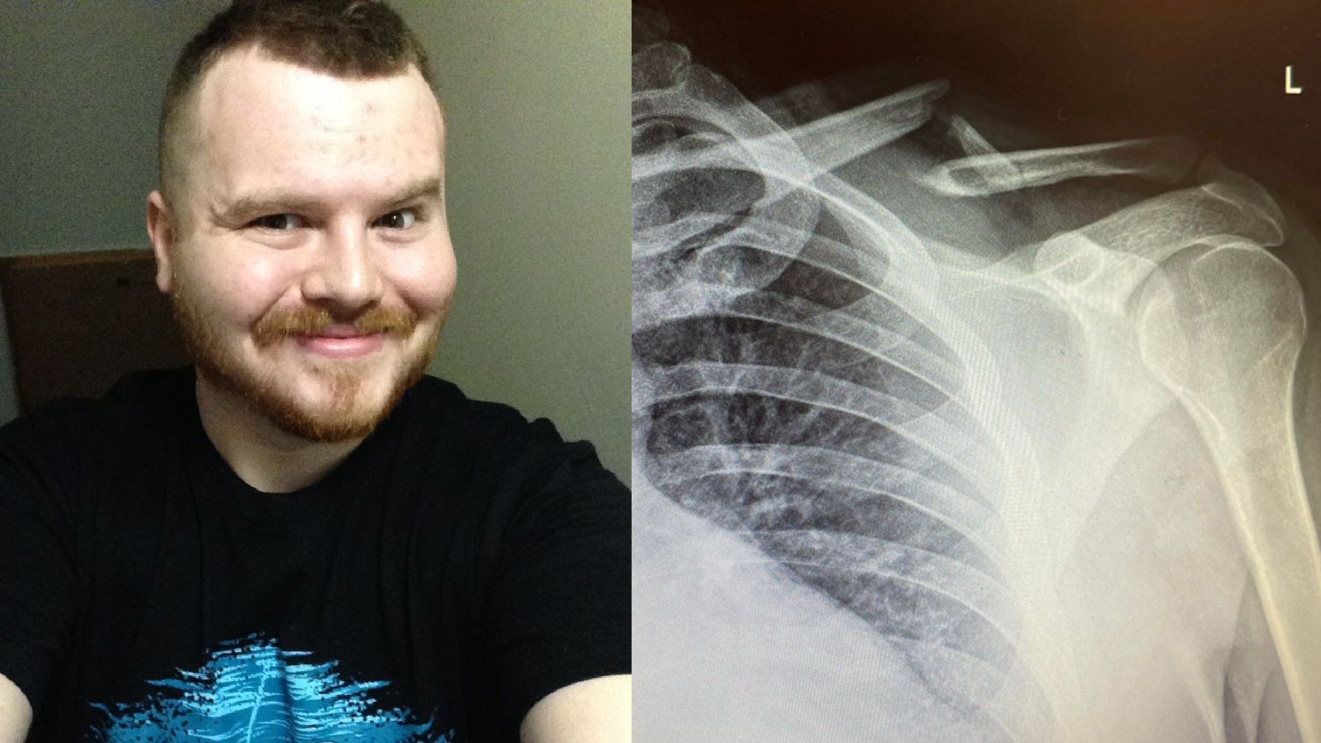 Skill Specs broke his collarbone while riding a bike on stream (Image via Skill Specs/Twitter)