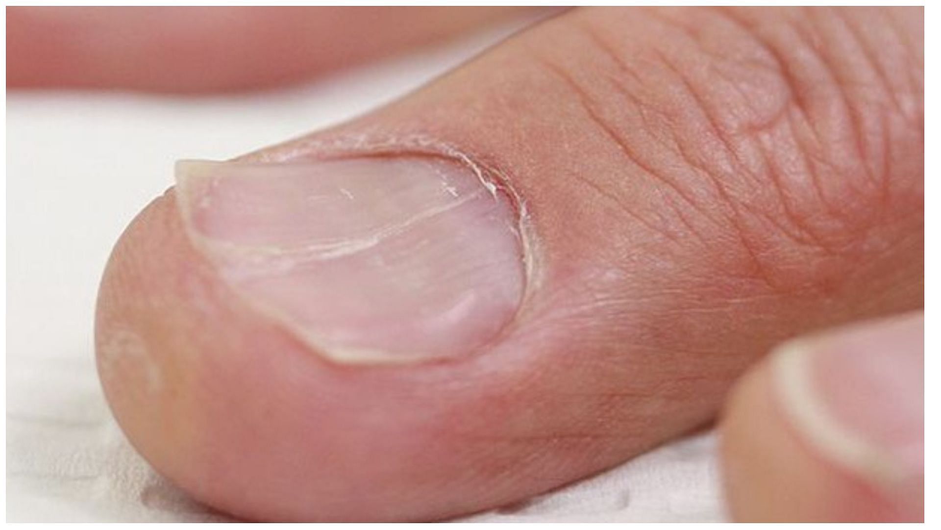 Onycholysis separation of fingernail from nail bed Stock Photo - Alamy