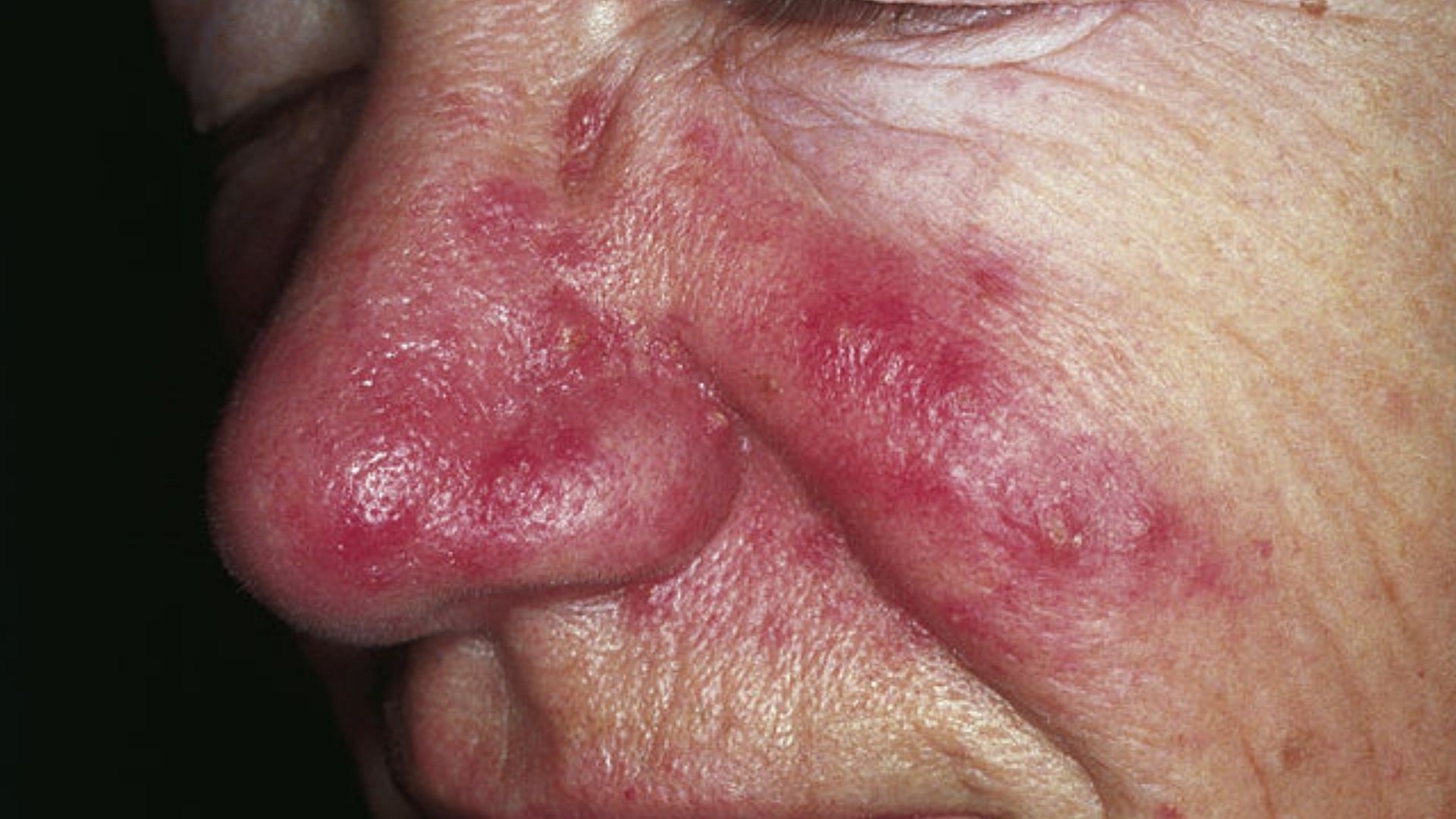 Rosacea can worsen if left untreated (Image via Flickr)