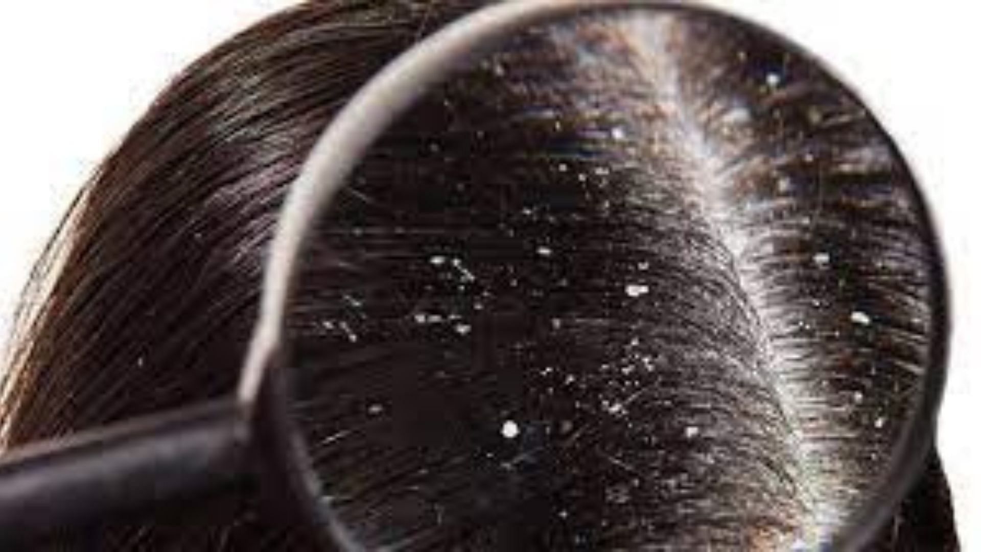 Dry scalp (Image via Google)