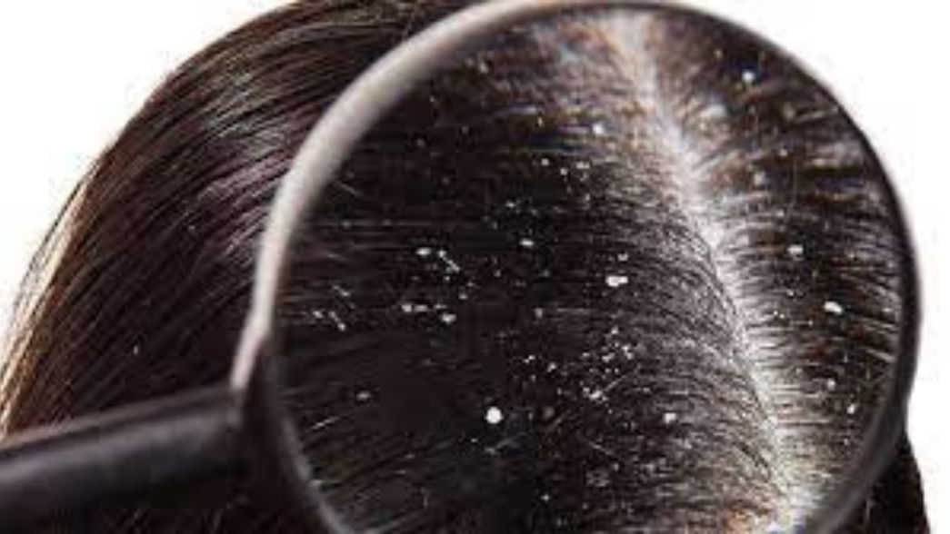 Dry Scalp vs Dandruff What's the Difference?