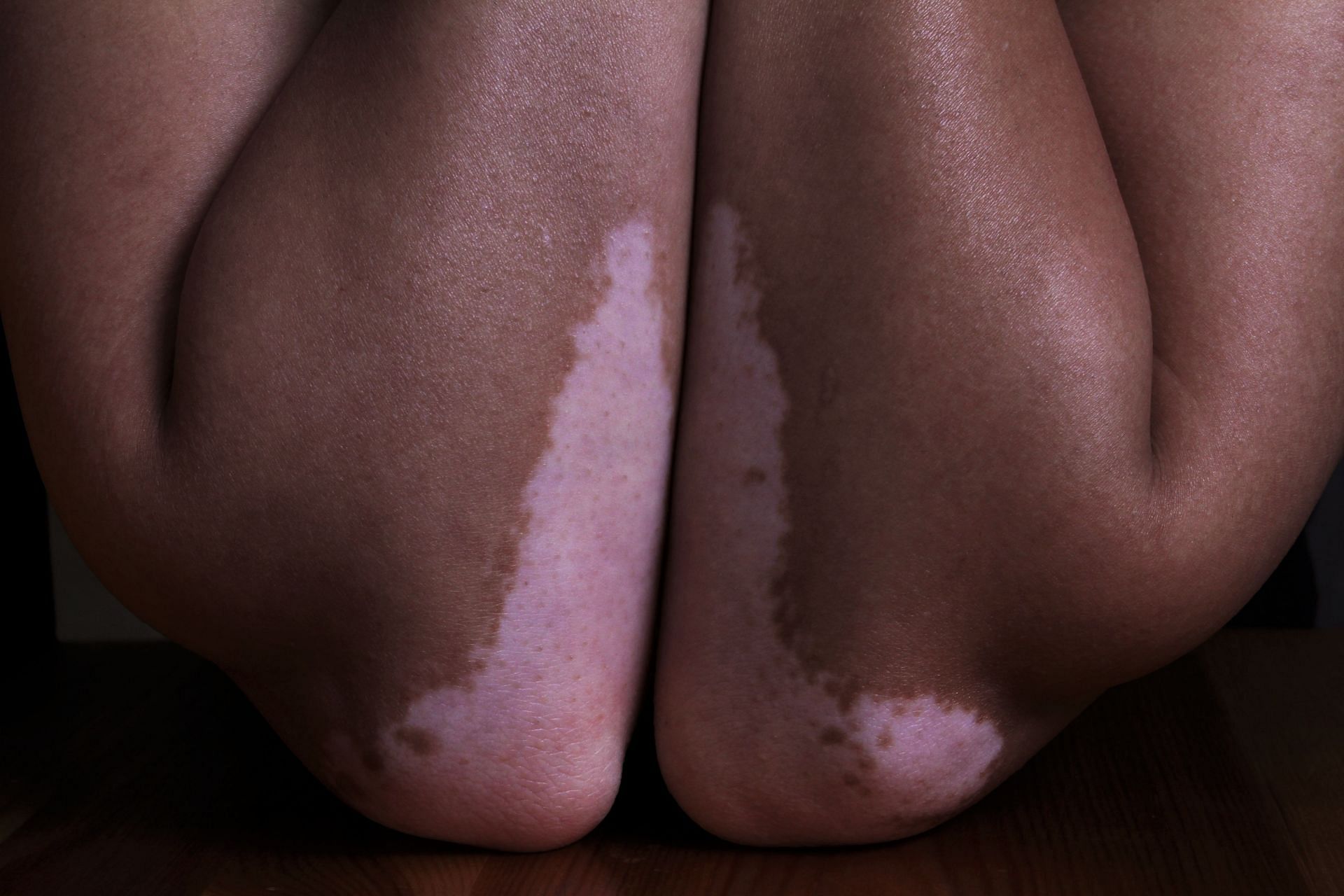 Vitiligo is characterized by skin patches (Image via Unsplash/Hanen BOUBAHRI)