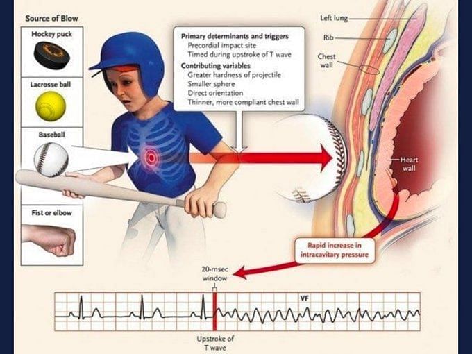 Hard tackle to the chest could have triggered a rare heart condition in Damar  Hamlin, doctors say