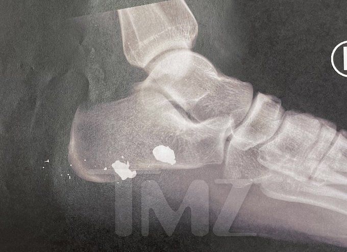 When was Megan Thee Stallion shot? Foot injury pictures surface from ...