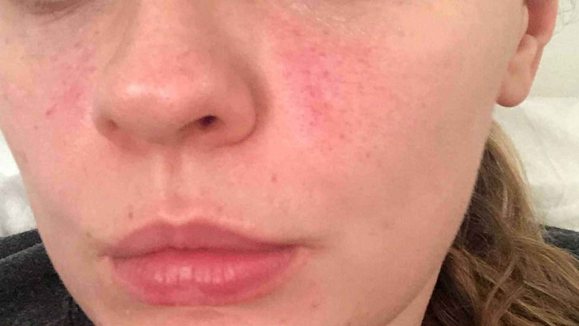 Rosacea on skin is a chronic inflammatory skin ailment (Image via Instagram)