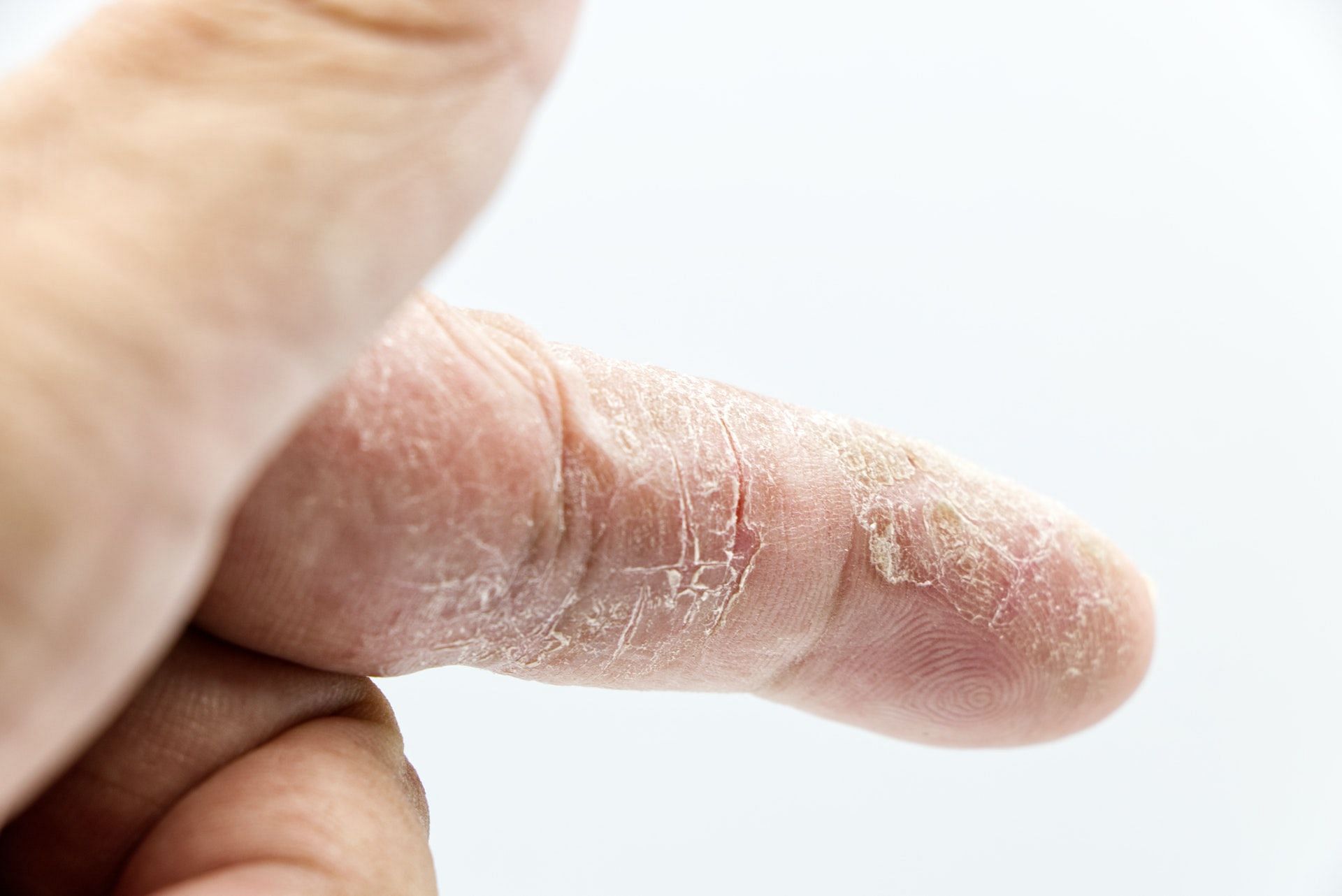 Different types of rashes can occur anywhere in the body. (Photo via Pexels/Srattha Nualsate)