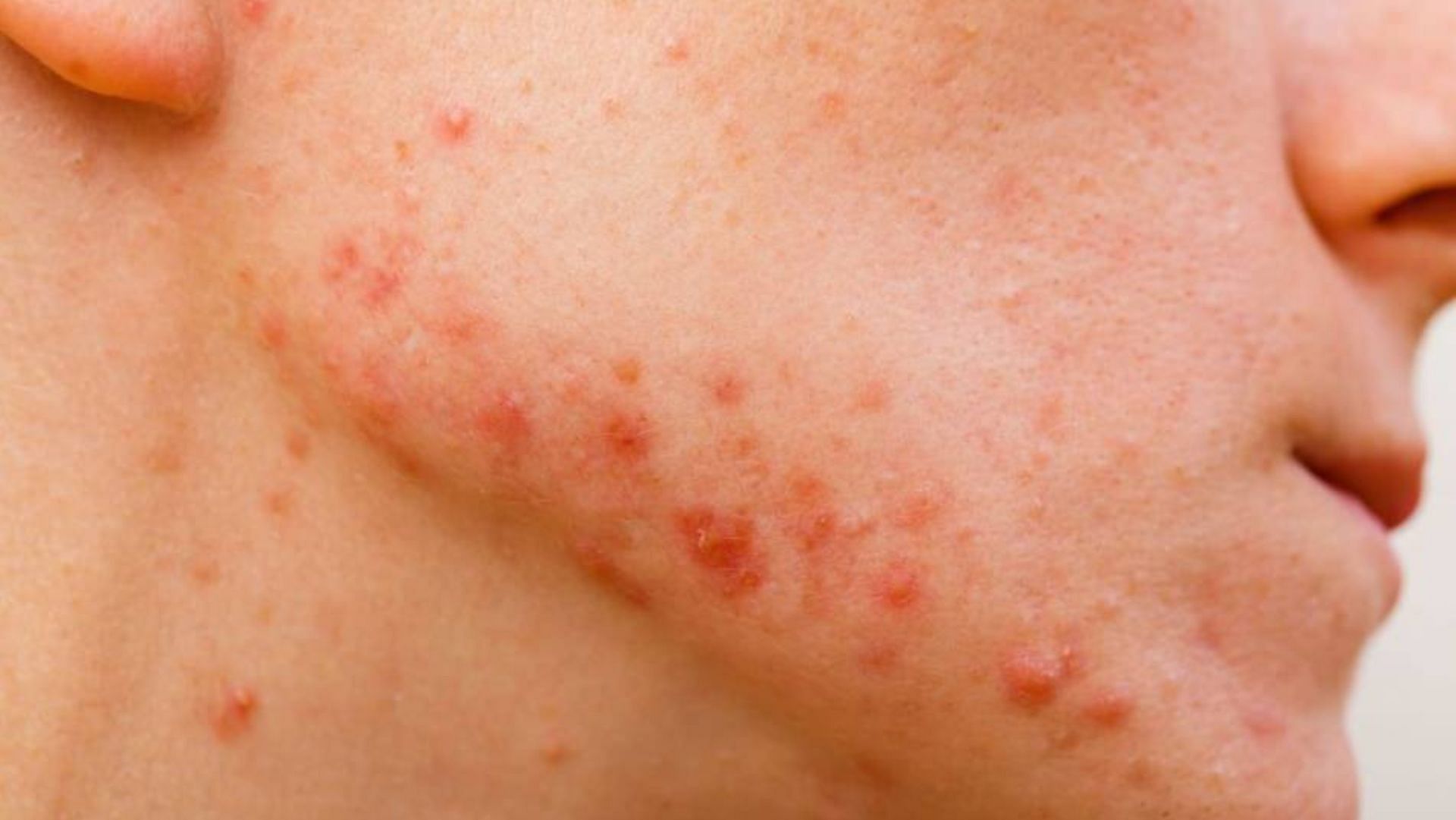 There are some basic lifestyle changes you can make in order to reduce acne problems. (Image via Flickr)
