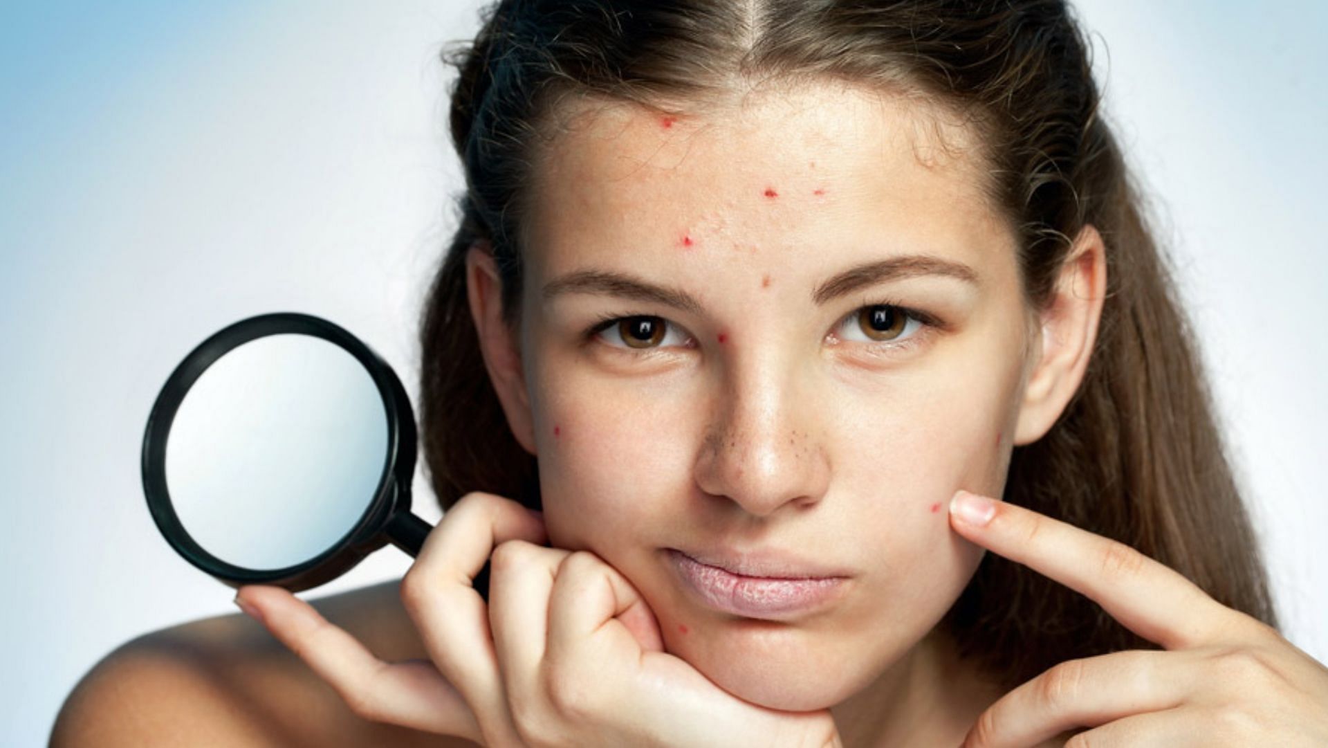 Retinoid creams are one of the OTC creams you can use for treatment of cystic acne. (Image via Flickr)