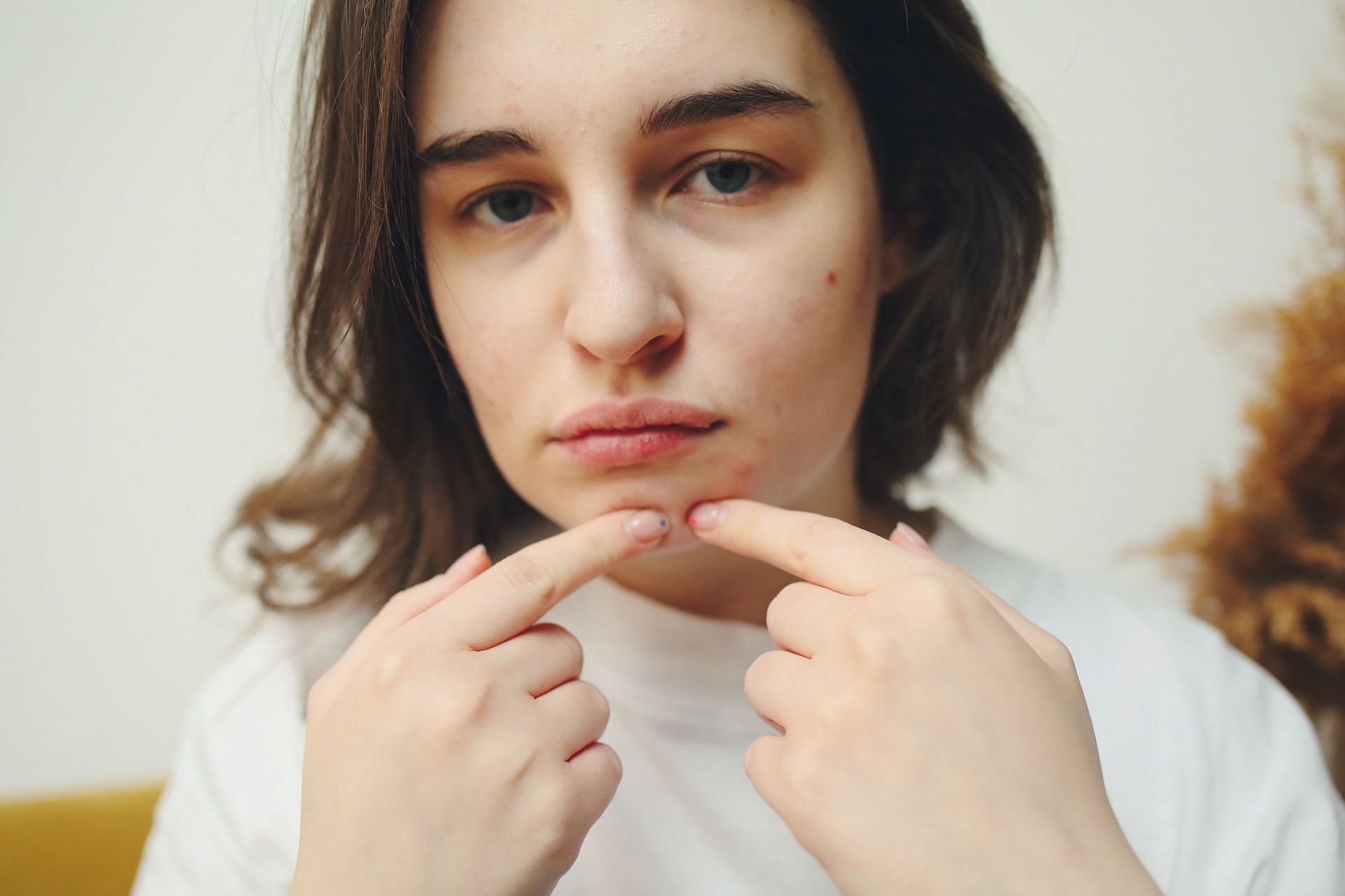 You shouldn&#039;t pop your acne, as it can lead to permanent scarring. (Image via Pexels/Polina Tankilevitch)