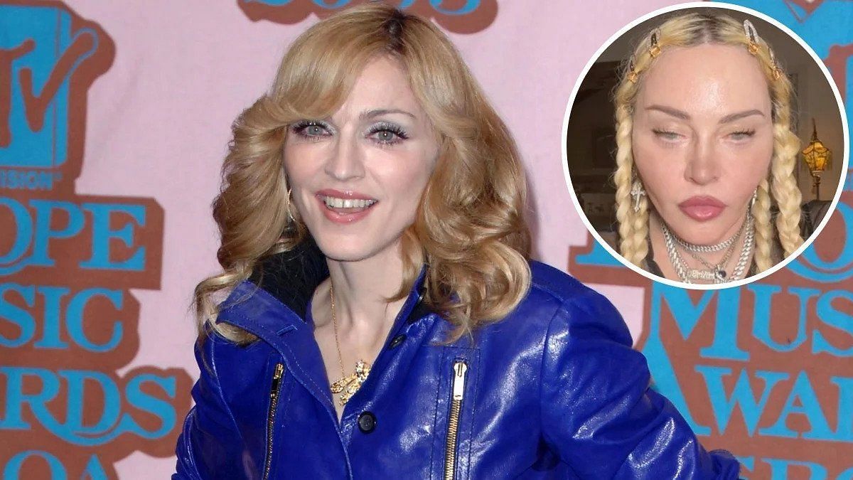 What Happened to Madonna’s Face? A Look into Her Plastic Surgery as