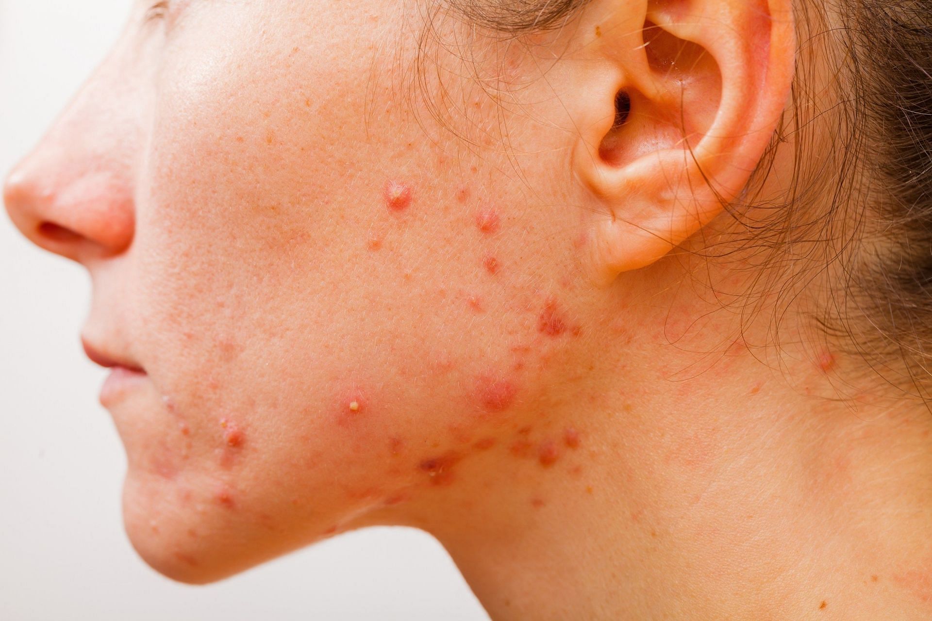 Cystic acne is the most severe form of acne (Image via Flickr)