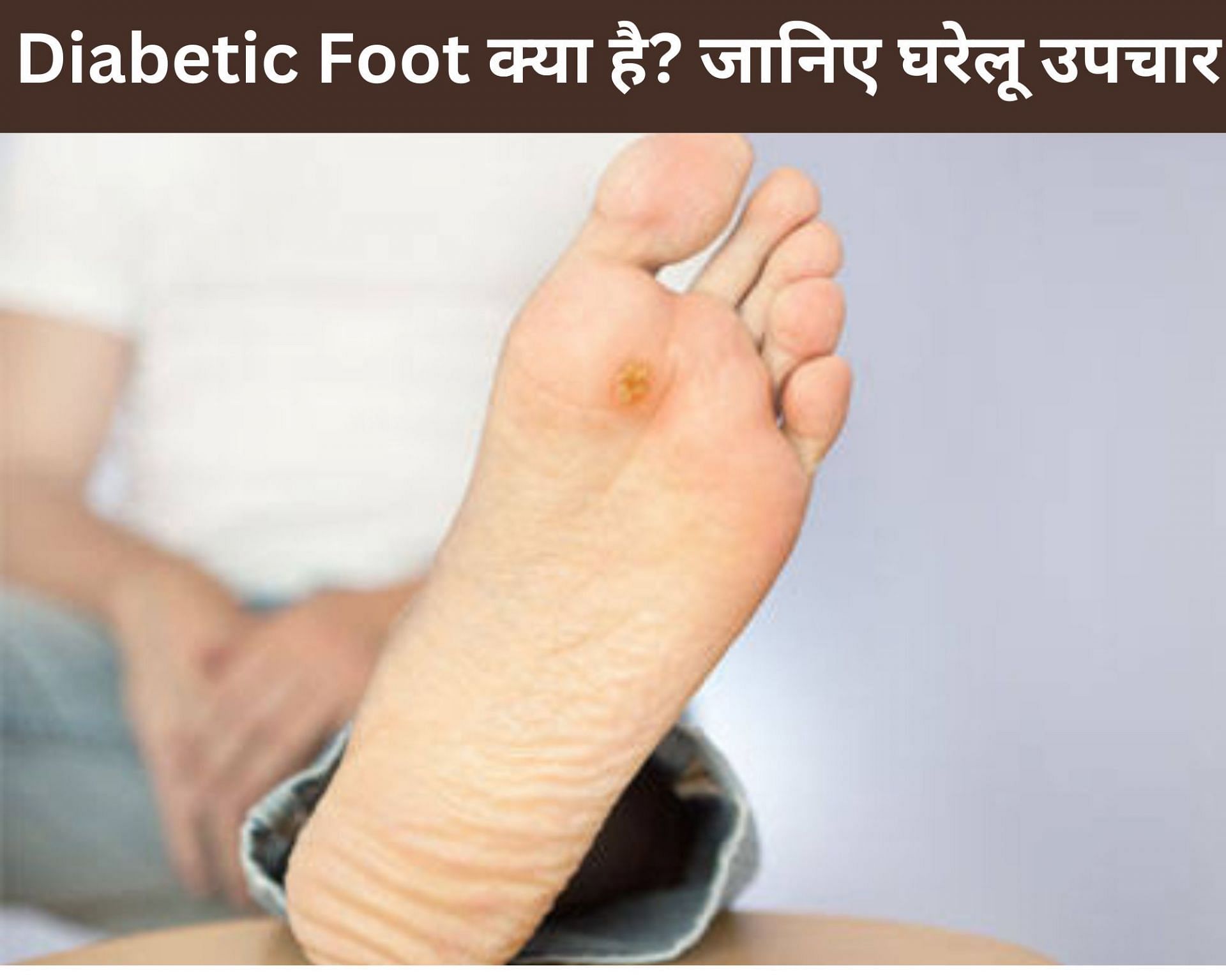 Diabetic Foot क्या है? जानिए 7 घरेलू उपचार (फोटो - sportskeedaहिन्दी)