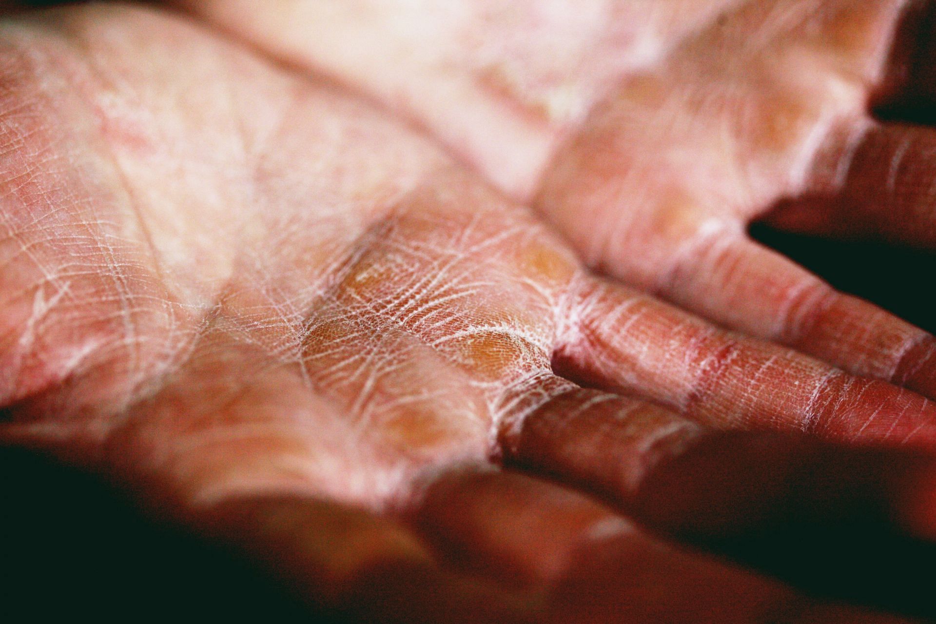 Dry skin can be an indicator of low iron in the body (Image via Unsplash @Alexander Grey)