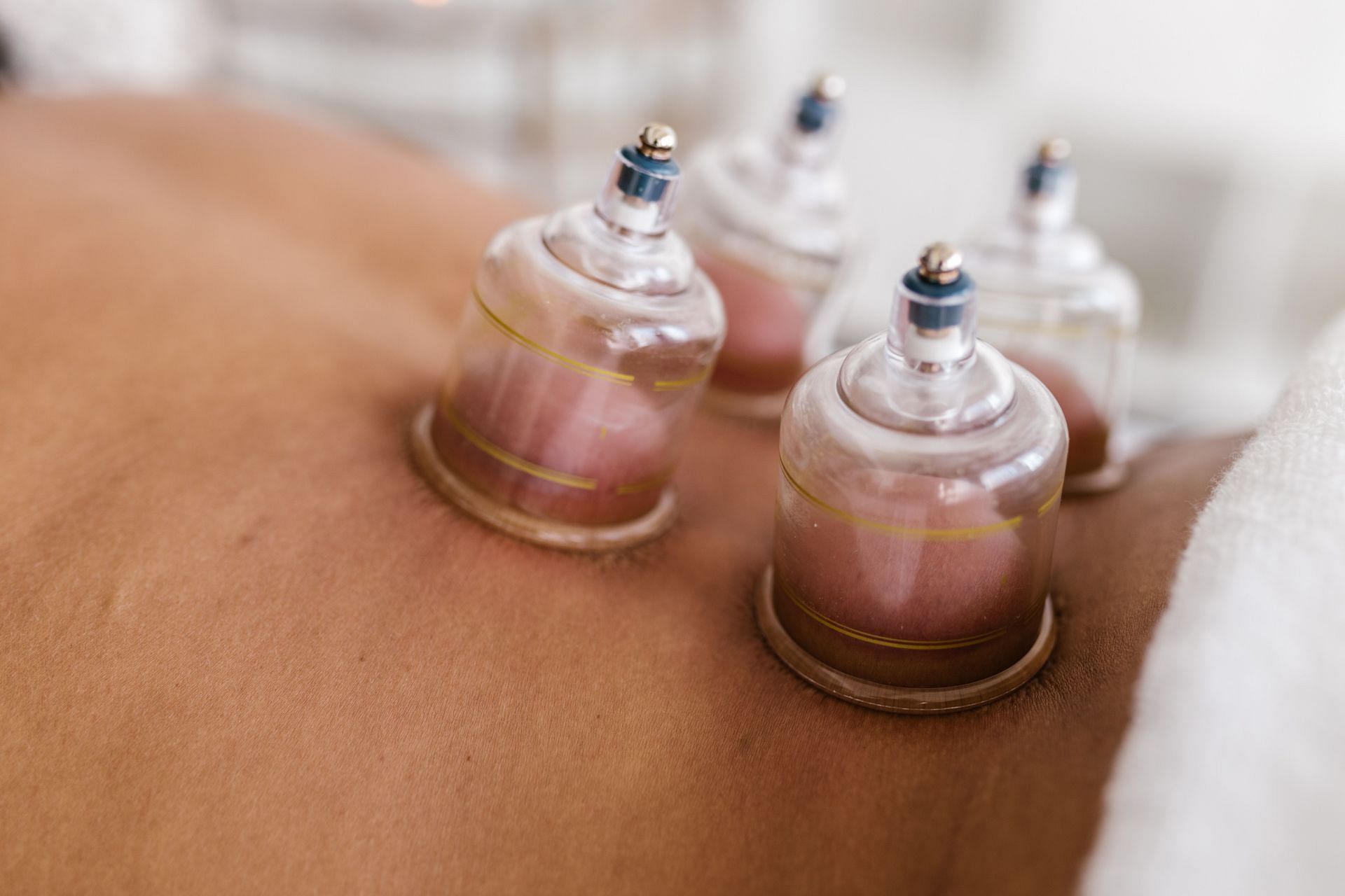 Bruising, pain, swelling, and red markings are unavoidable side effects of cupping. (Image via Pexels/ Rodnae Productions)