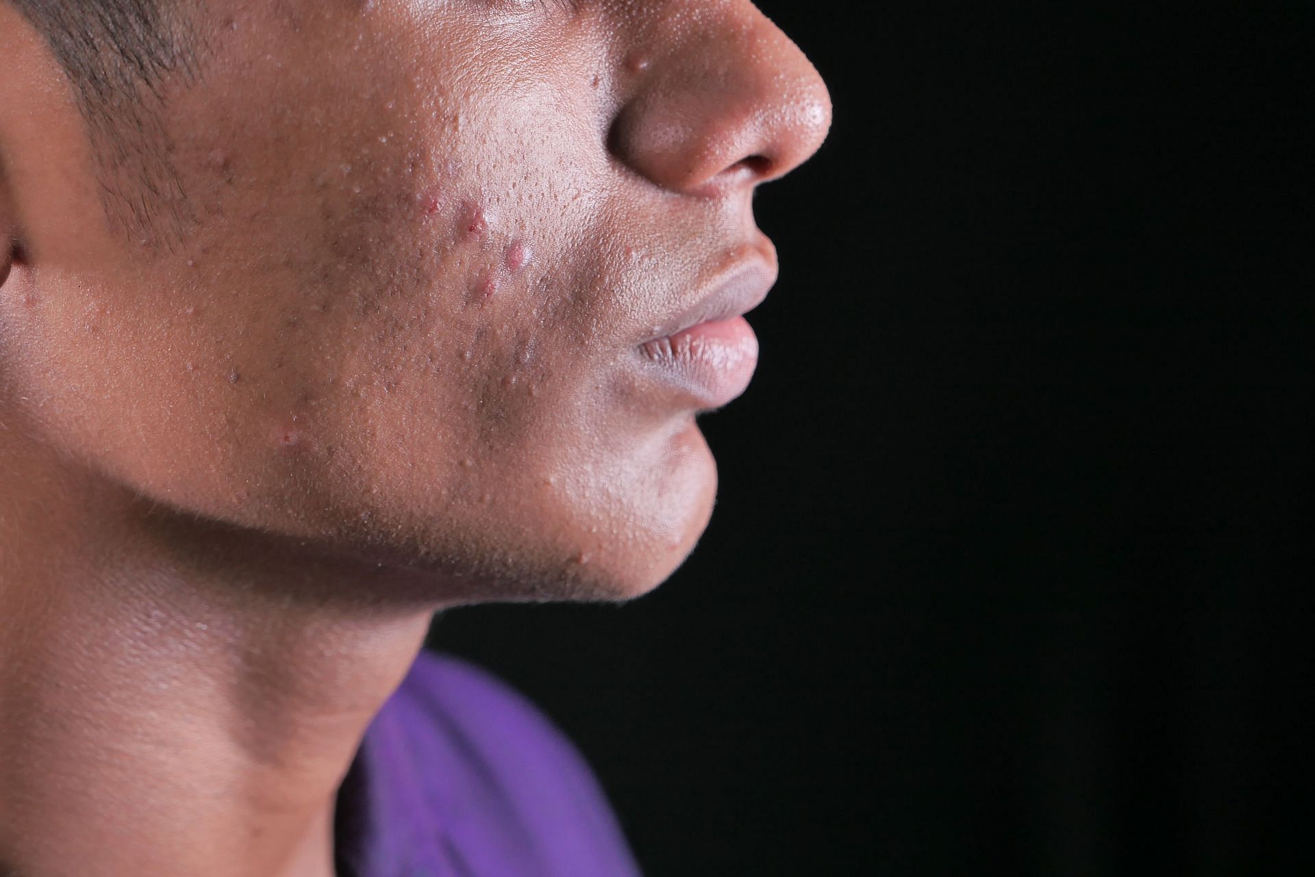 Clear bumps on skin could be causes by bacterial or viral infection. (Image via Pexels / Towfiqu Barbhuiya)