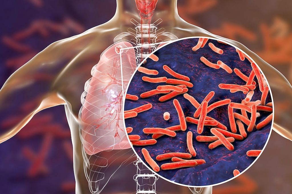 Keep TB at Bay: 5 Effective Ways to Prevent Tuberculosis