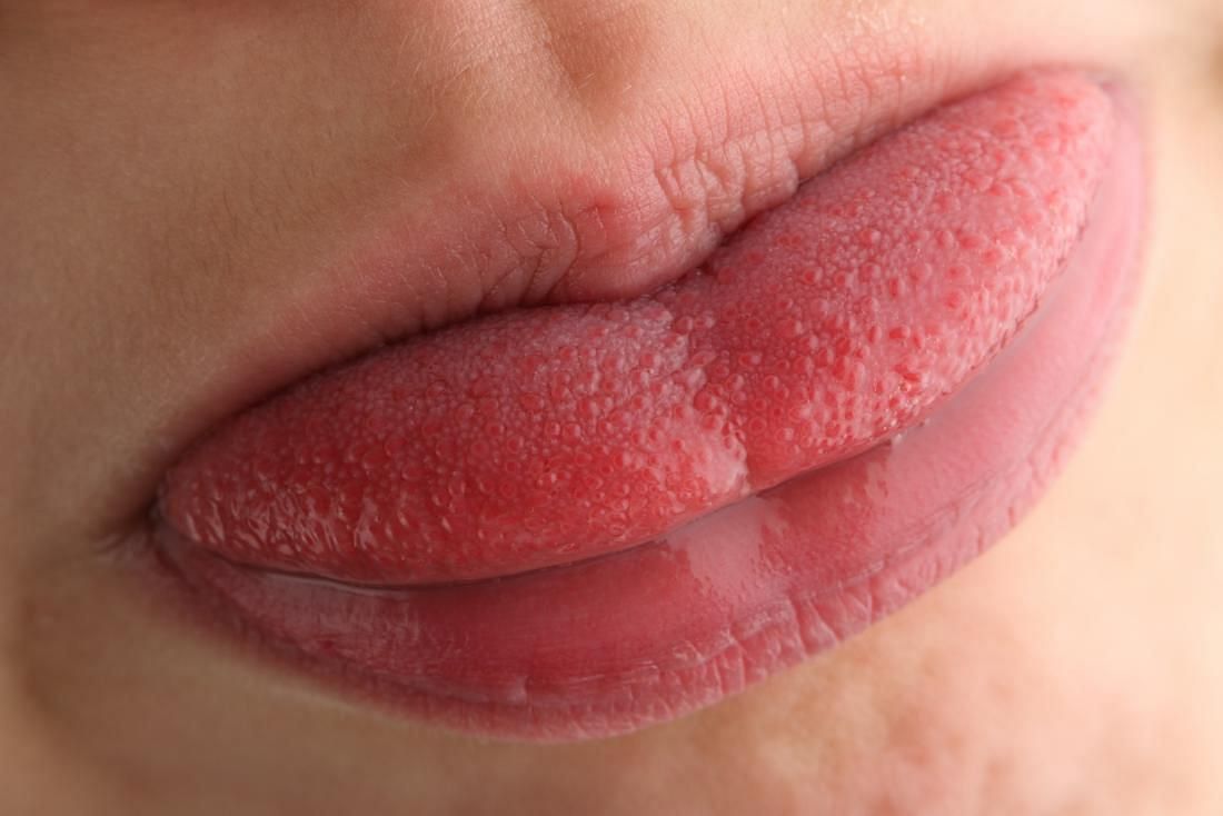 Some home remedies can help for swollen taste buds (Photo by medical news today)