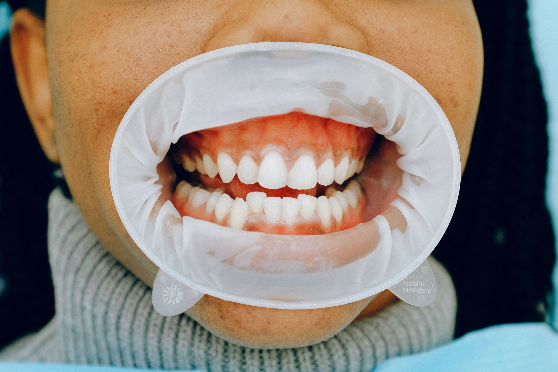 Gingivitis and Its Causes, Symptoms, and Treatment(Image via Pexels/Anna Shevts)