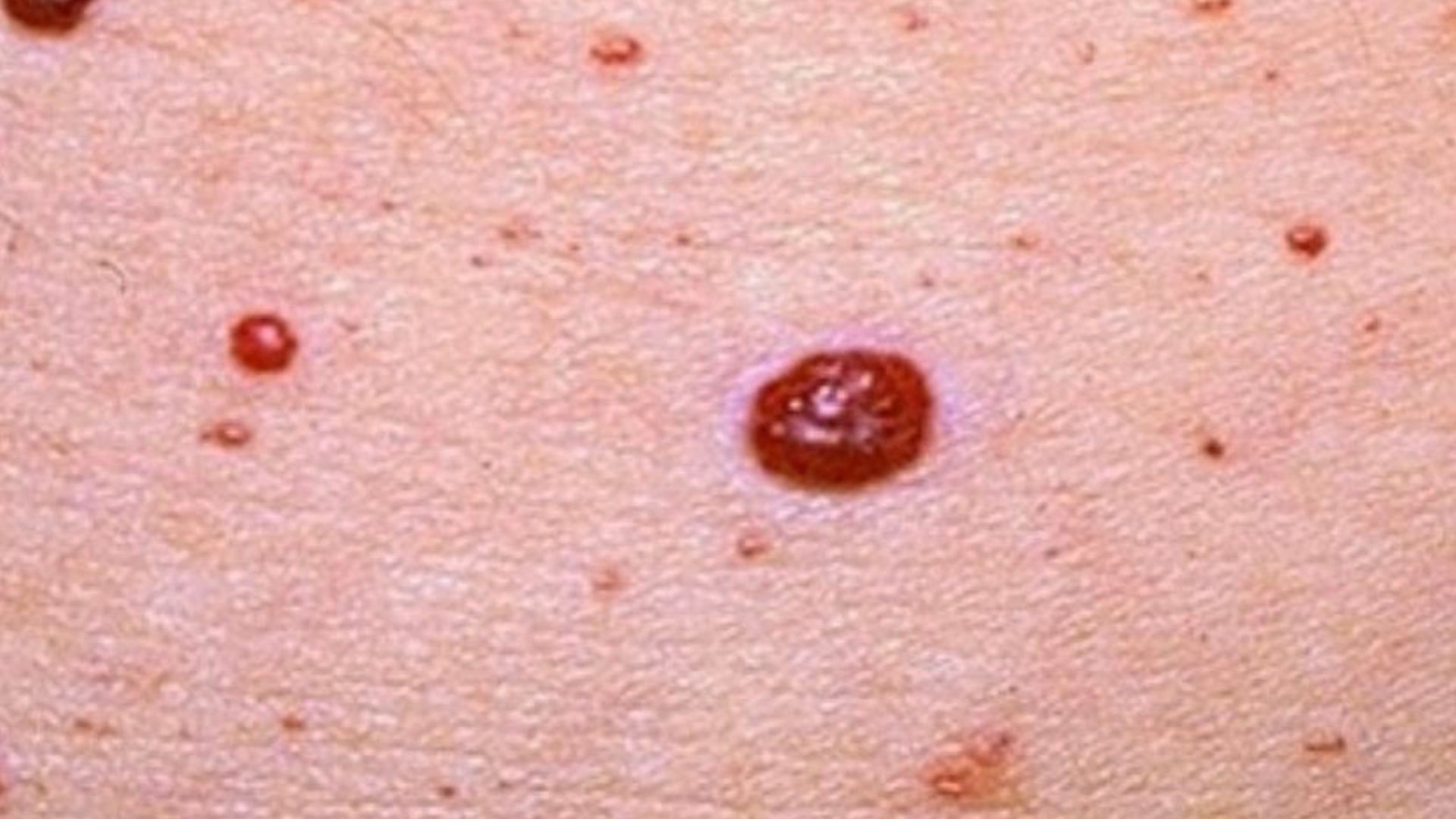 Age and genes are two of the most common causes of red moles on skin. (Photo via Instagram/theanatomynerdpodcast)