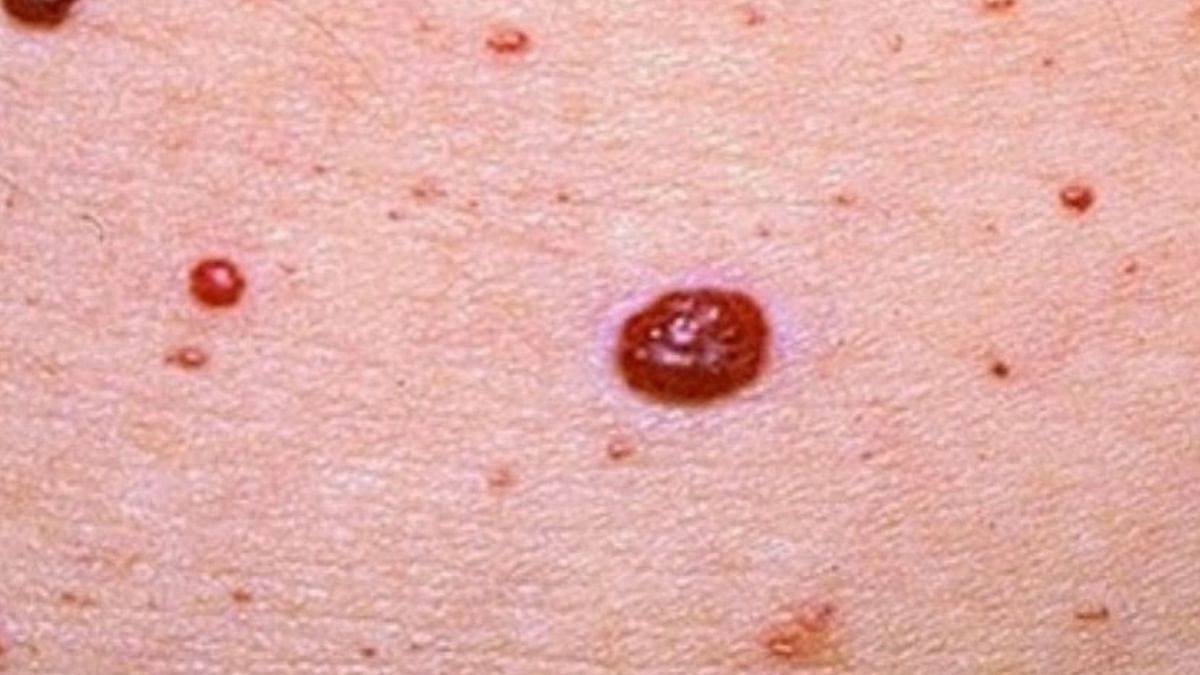 Red Moles On Skin Causes And Treatment Options 