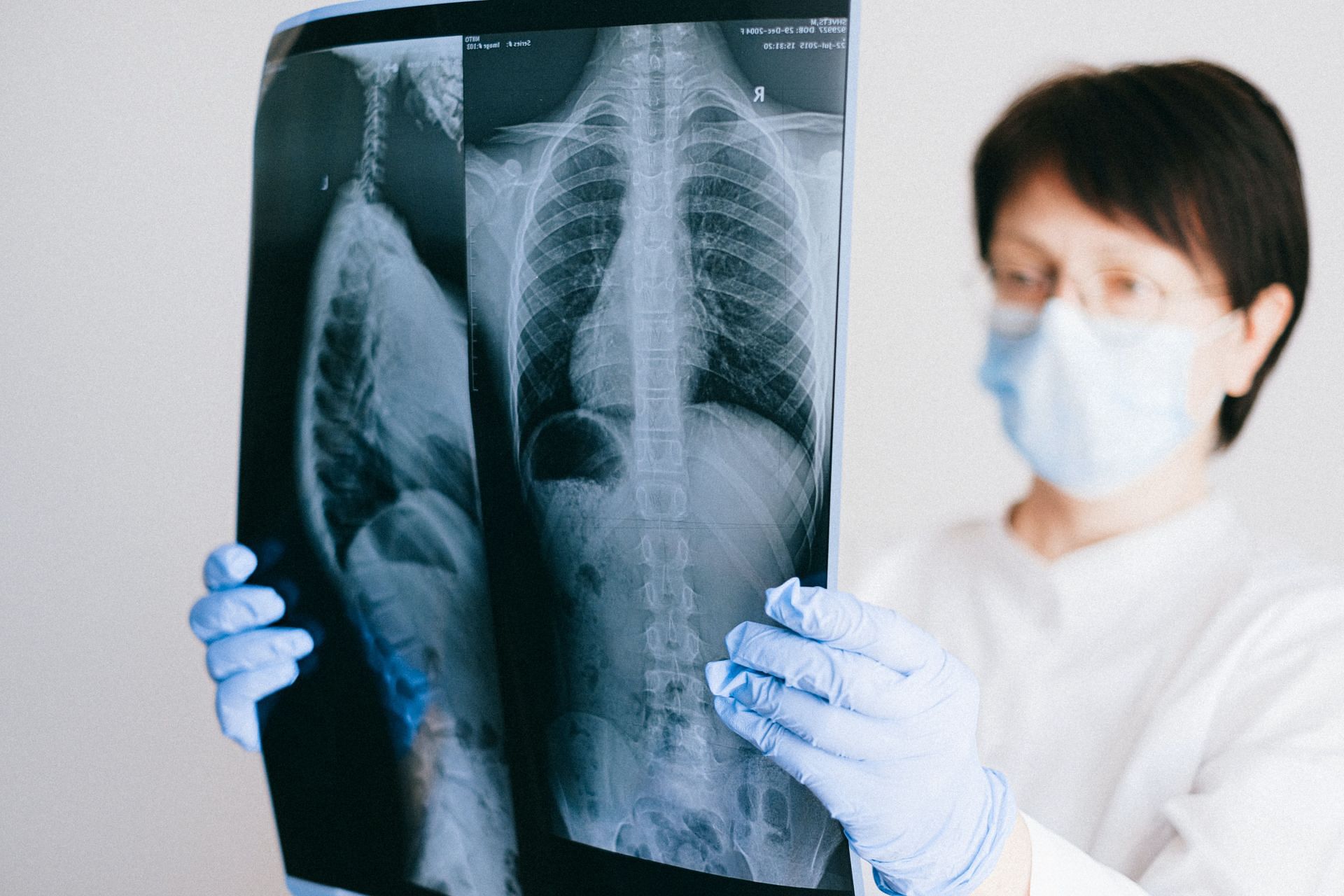 An X-ray of the chest often does not indicate latent TB, hence it can be quite difficult to diagnose this disease (Image via Pexels @Anna Shvets)