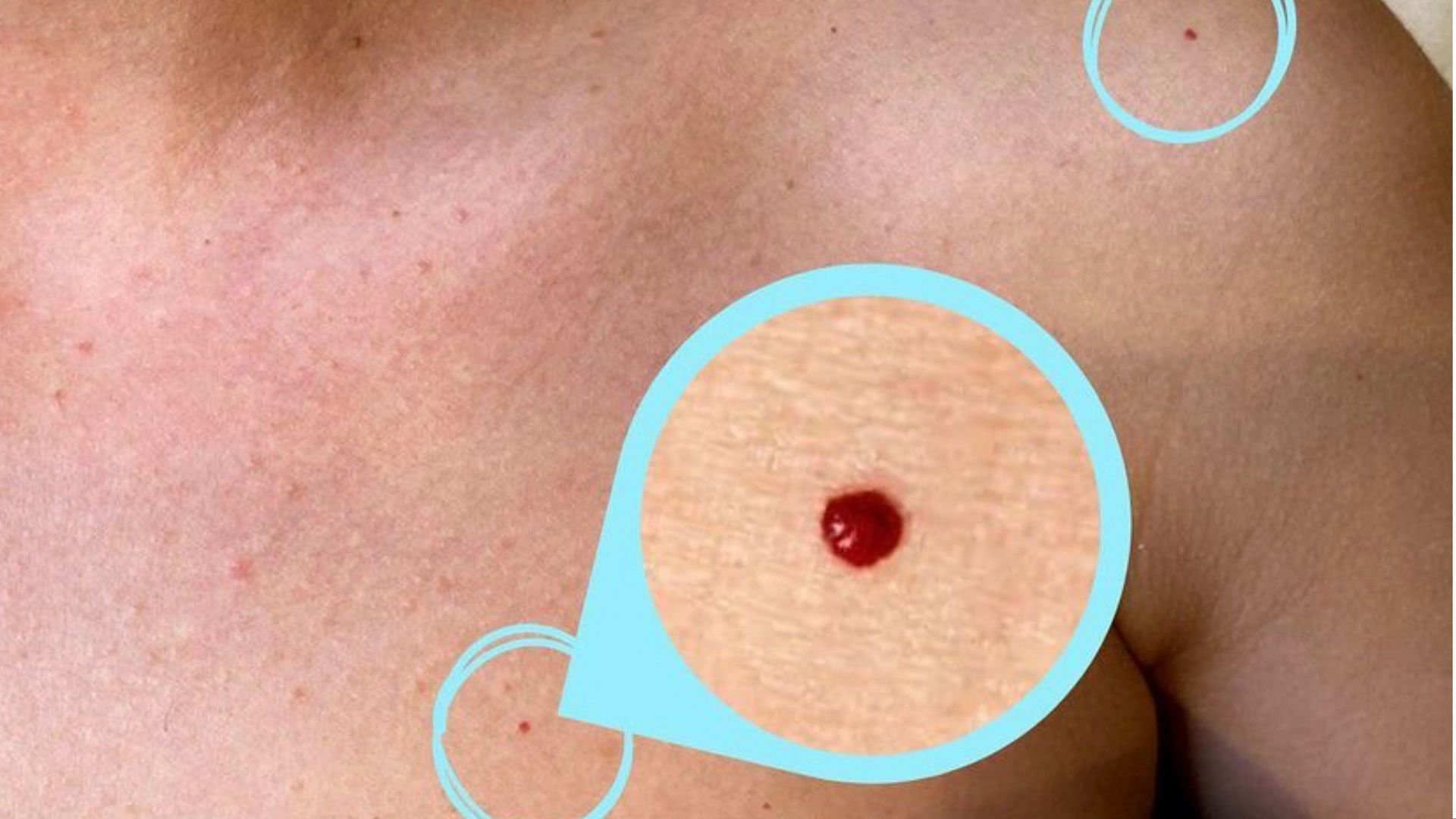 Red moles on the skin is also called as cherry angioma. (Photo via Instagram/beautynowmedspa)