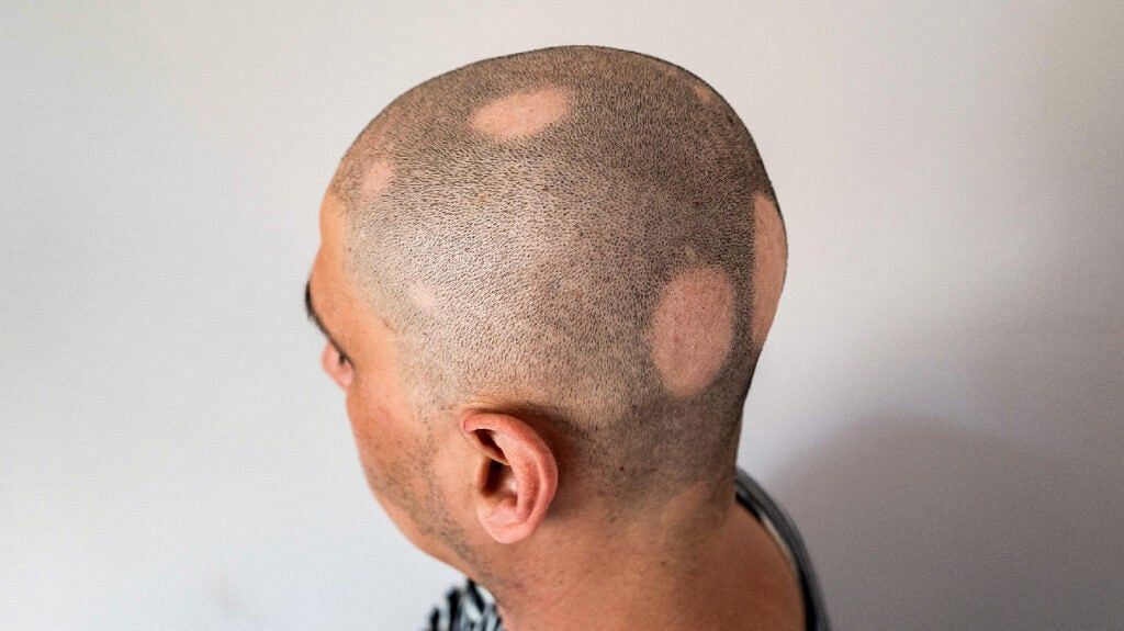 Alopecia areata leads to hair loss (Igor Novakovic/ Getty Images)