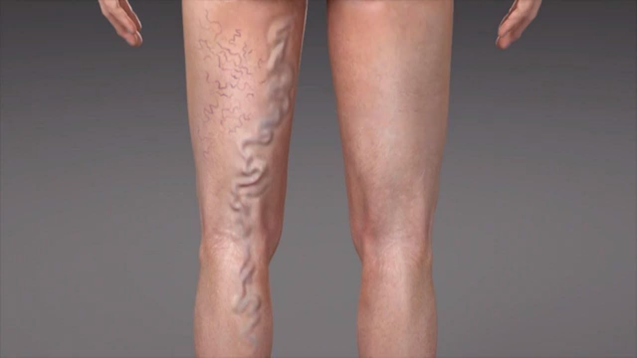 Everything You Need to Know About Treatment Of Varicose Vein: Pain Relief and Removal Options (Image via Youtube/Cleaveland Clinic)