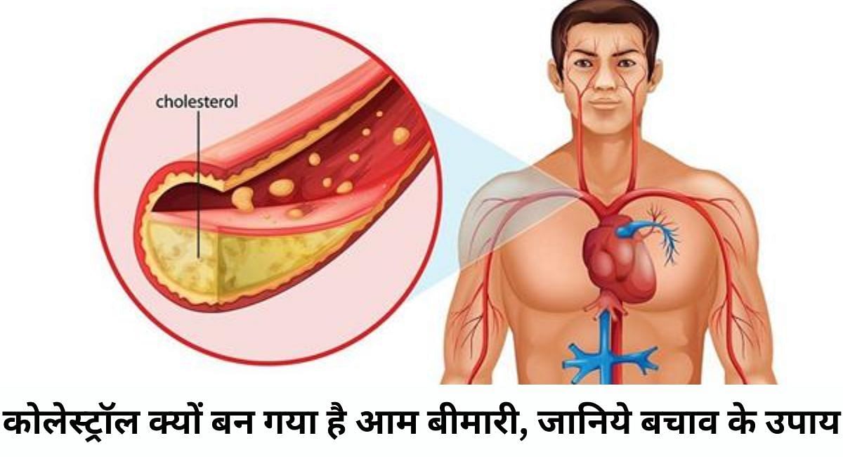 कोलेस्ट्रॉल क्यों बन गया है आम बीमारी, जानिये बचाव के उपाय 