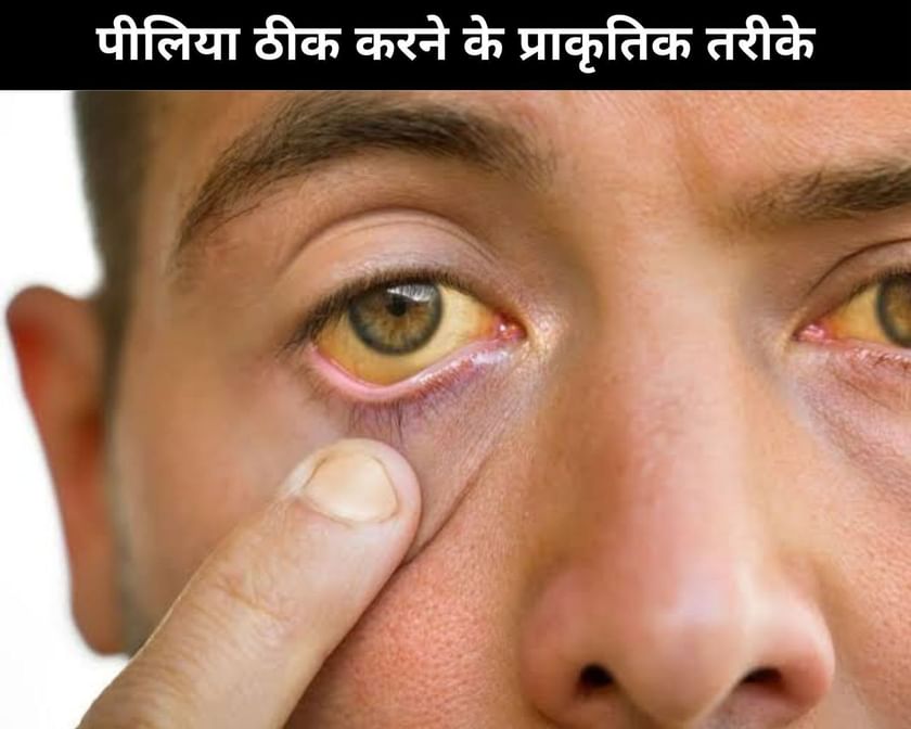 9 Natural Ways To Cure Jaundice In Hindi पीलिया ठीक करने के 9