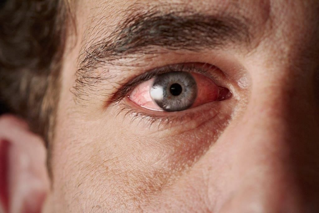 If your eyes are swollen, be sure to get them checked! (Image source/ Metrolina Eye Assocaites)