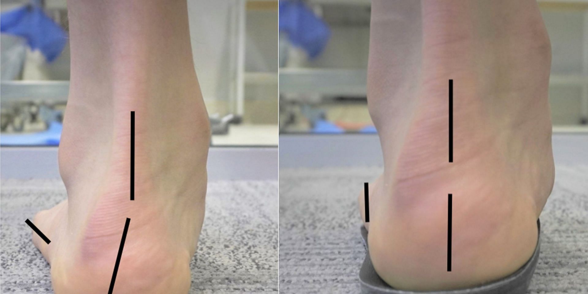 High heels can also cause plantar fasciitis. (Image via Adelaide Foot and Ankle)
