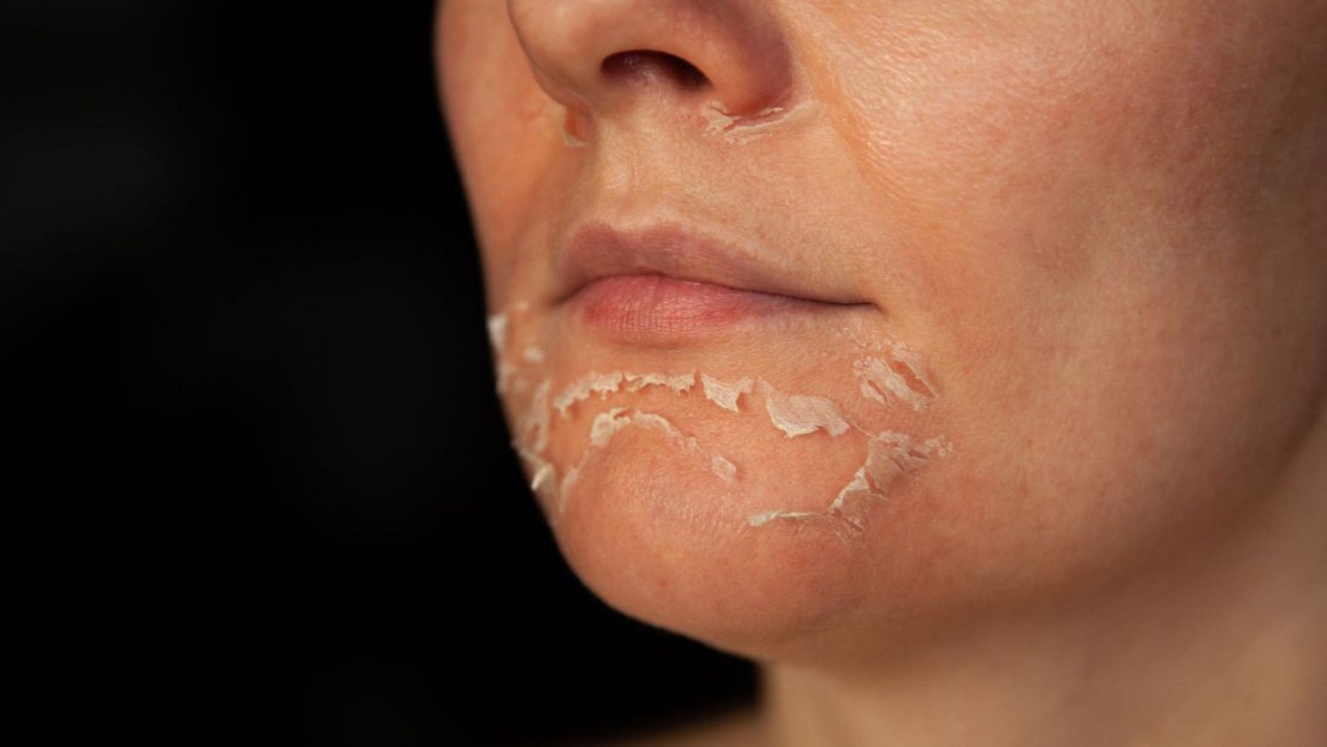 Skin peeling (Image via Google)