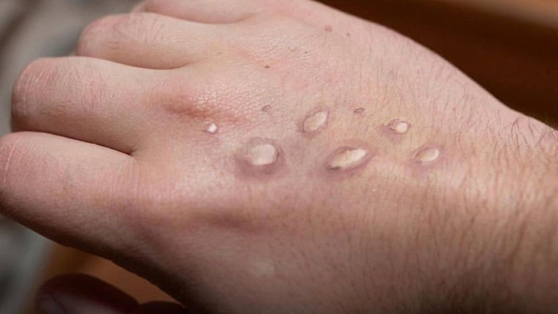 What's monkeypox?' Woman with 'insane rash' turned away for testing