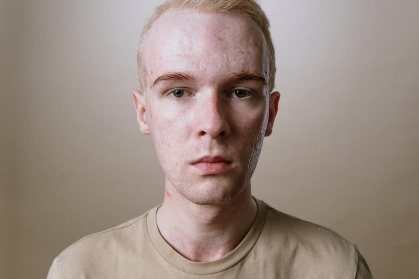 What causes a puffy face Major reasons why you have a swollen face in