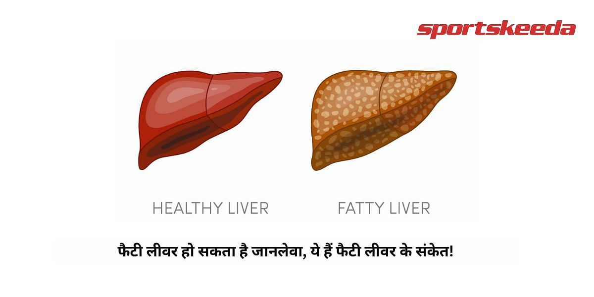 Fatty liver can be fatal, these are the signs of fatty liver!