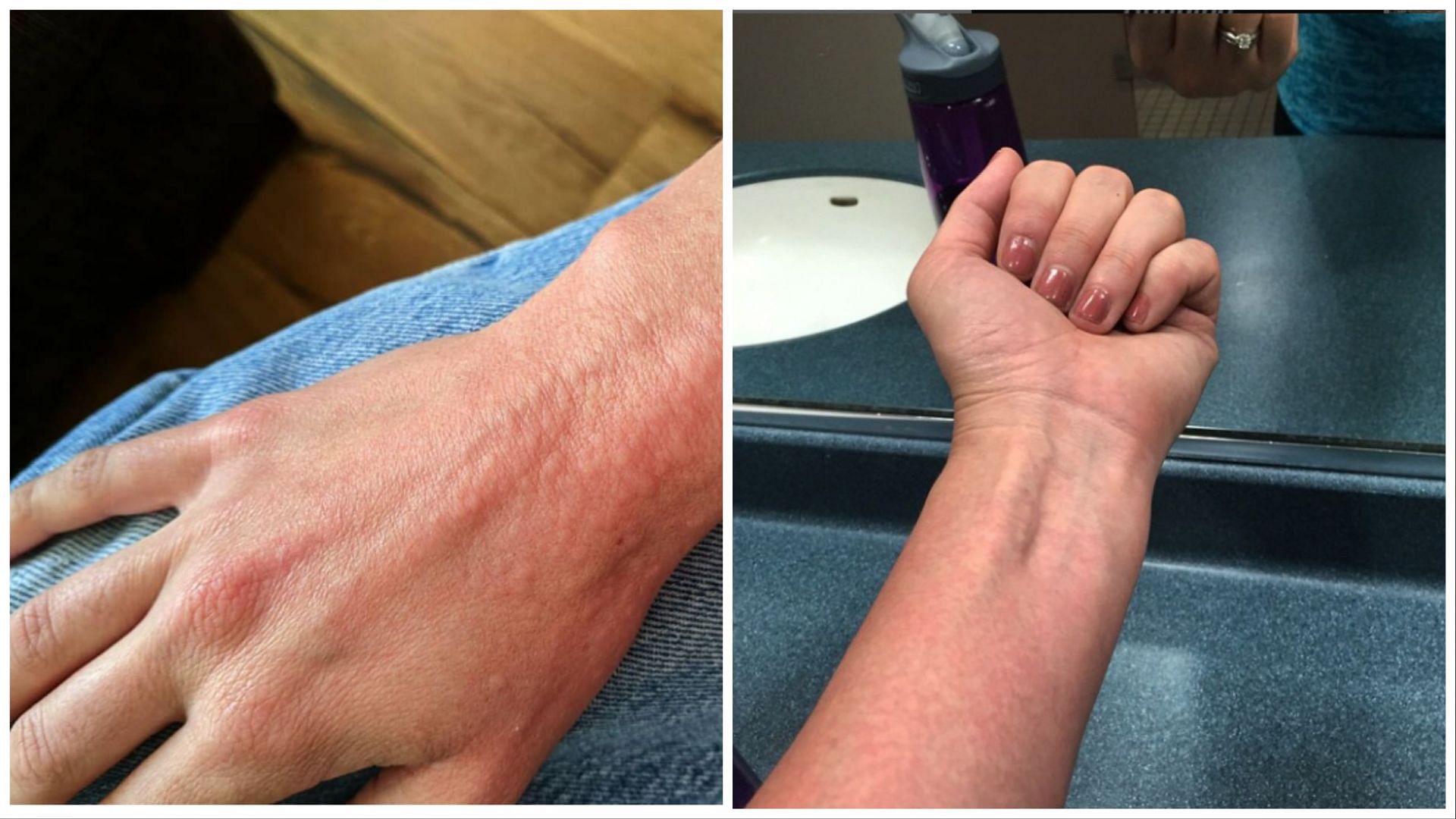 How to manage exercise-induced urticaria? (Image via instagram @adventuresofbink)