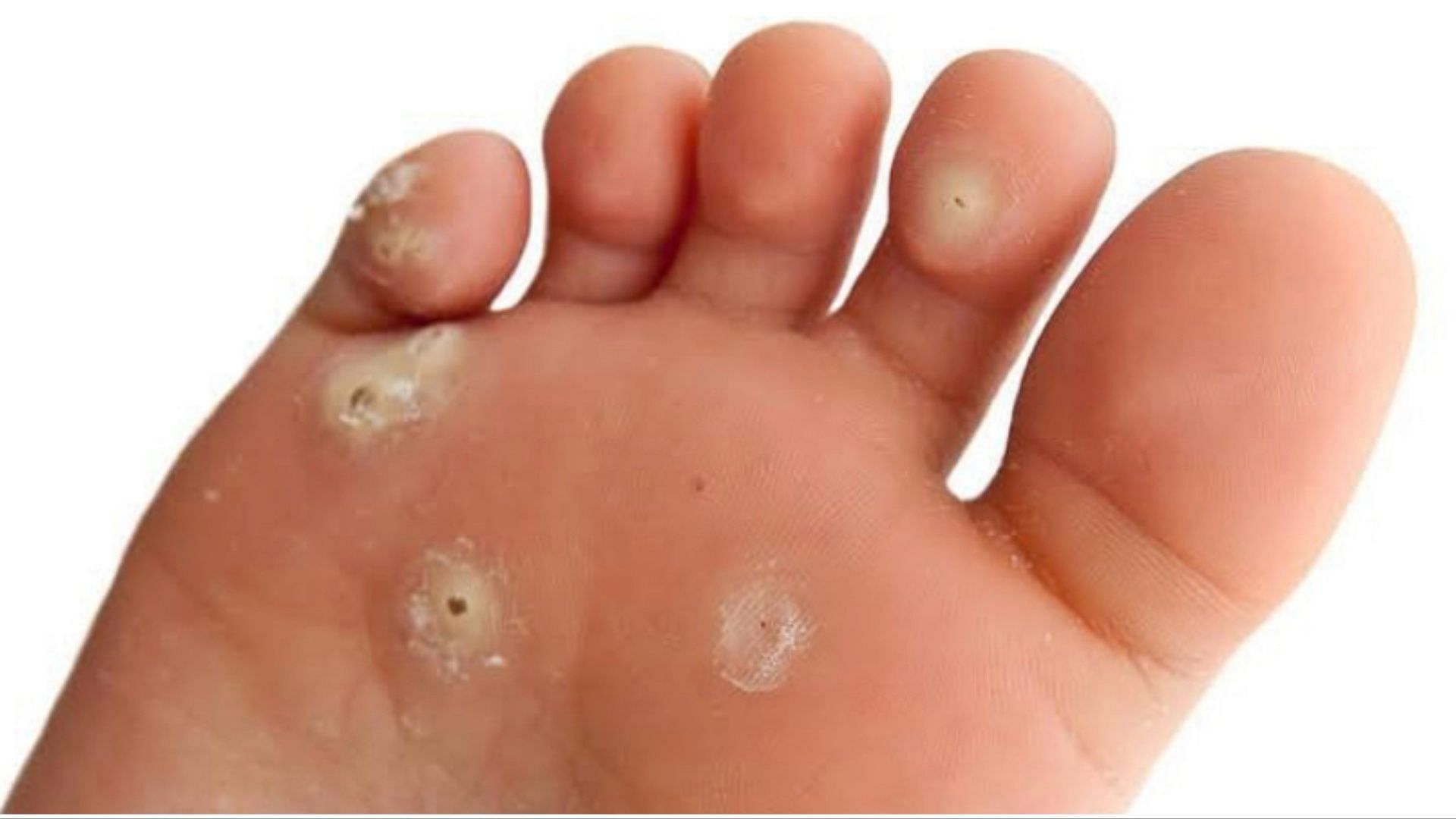 Plantar warts are caused by the HPV virus. (Photo via Instagram/podiatryfirst)