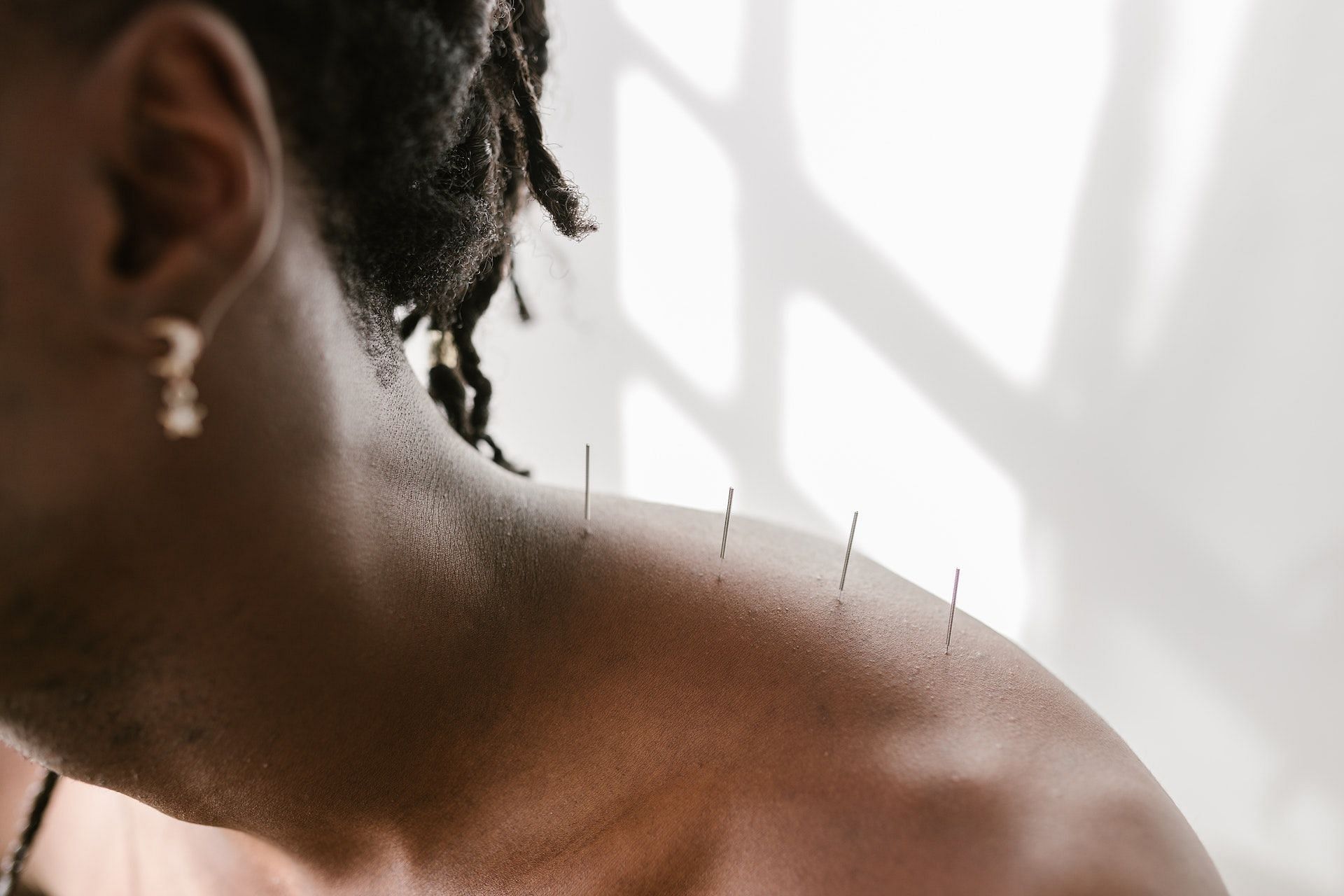 Acupuncture promotes the release of endorphins. (Photo via Pexels/RODNAE Productions)