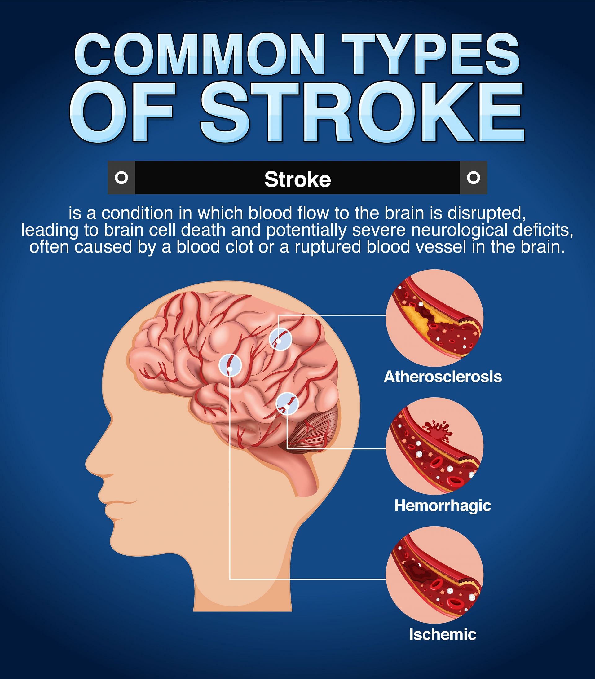 If you notice closely, you&#039;ll find the answer to can stroke cause dementia lies close to understanding cognition. (Image via Freepik/Freepik)