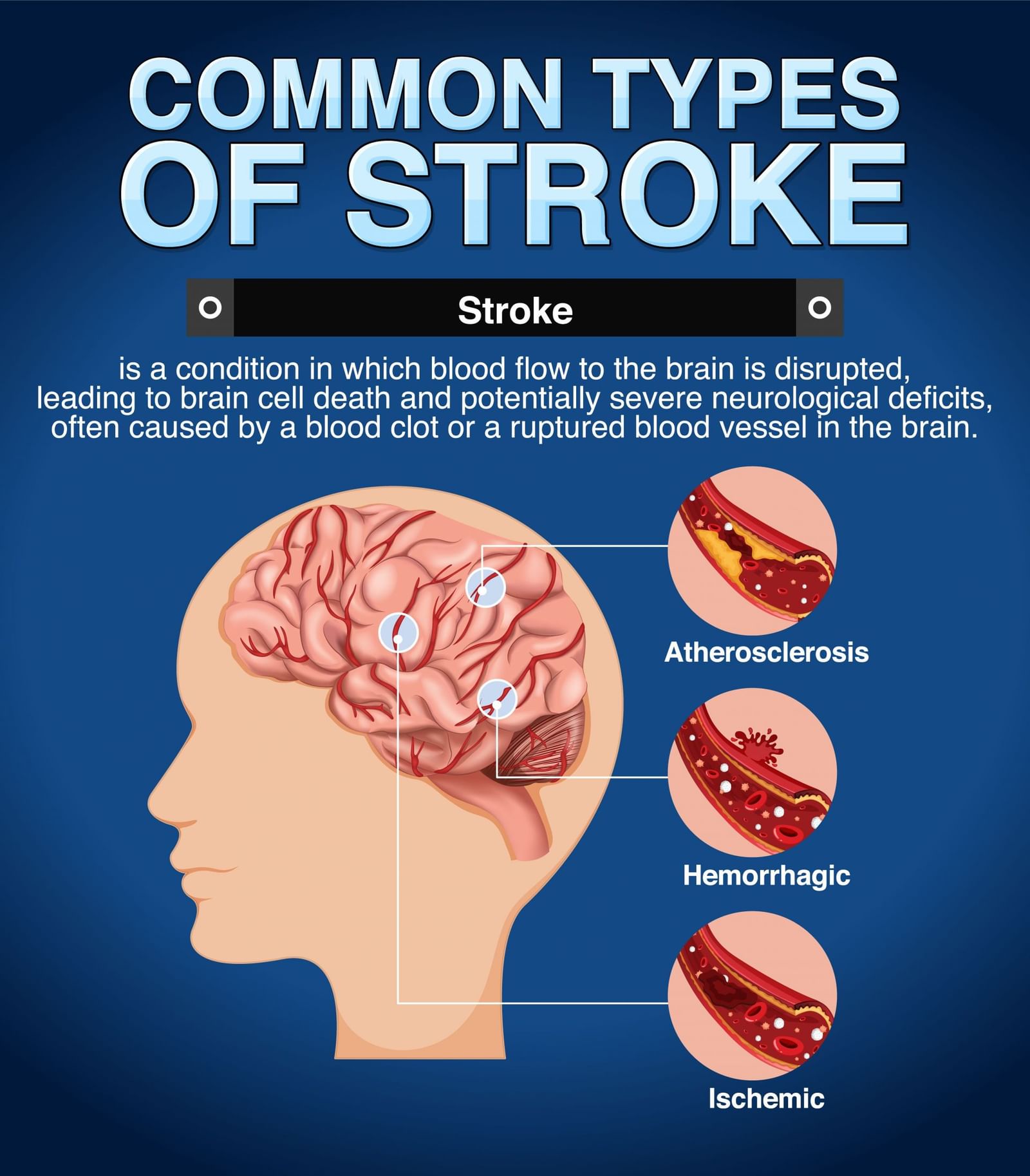 4 main types of dementia Can stroke cause dementia Exploring the link