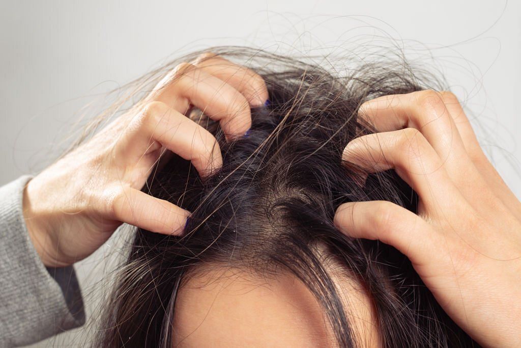 Beyond Poor Hygiene: 5 Unexpected Causes of Dandruff You Need to Know About (Image via iStockPhoto)