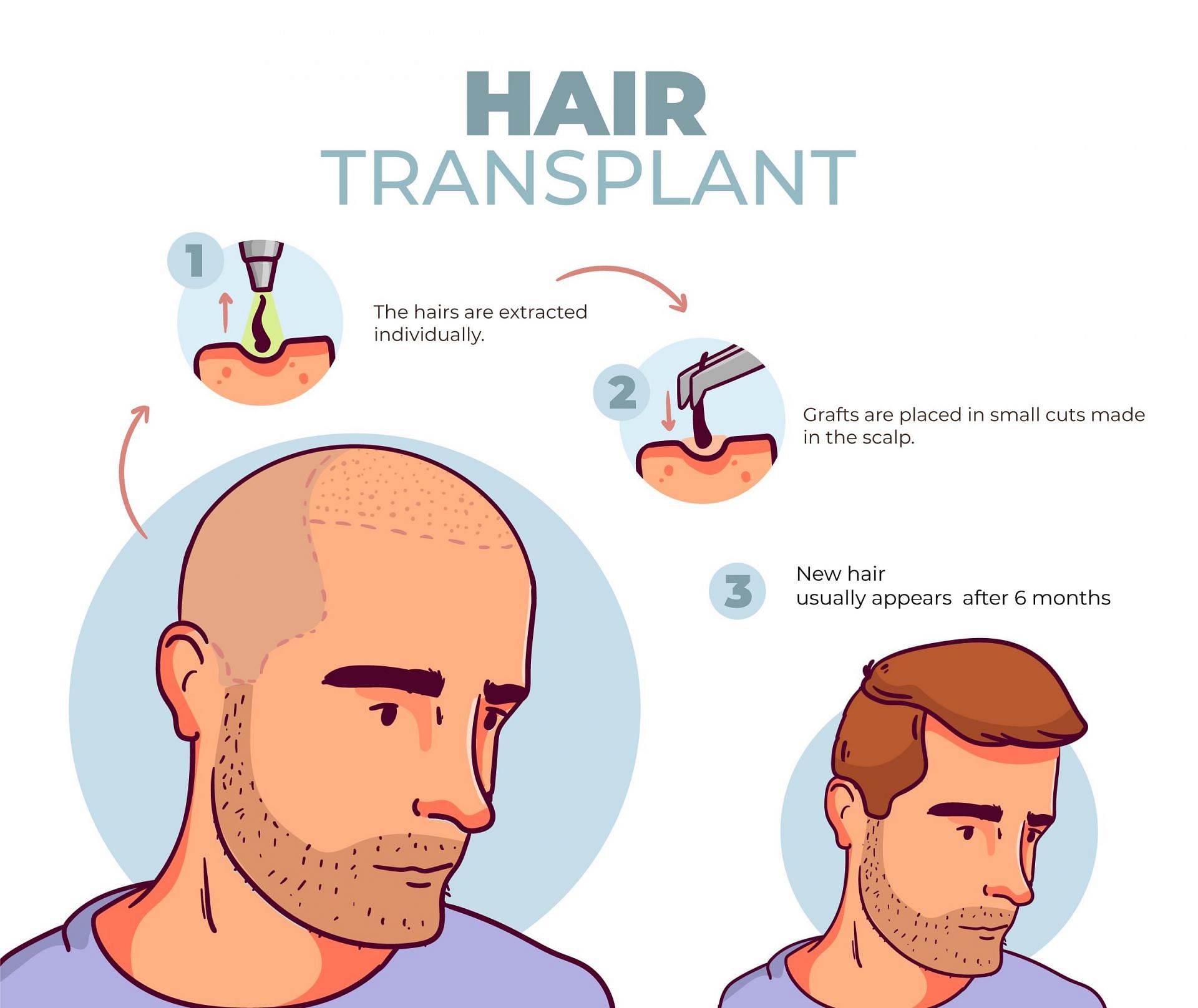 hair transplantation procedure. (image via freepik)