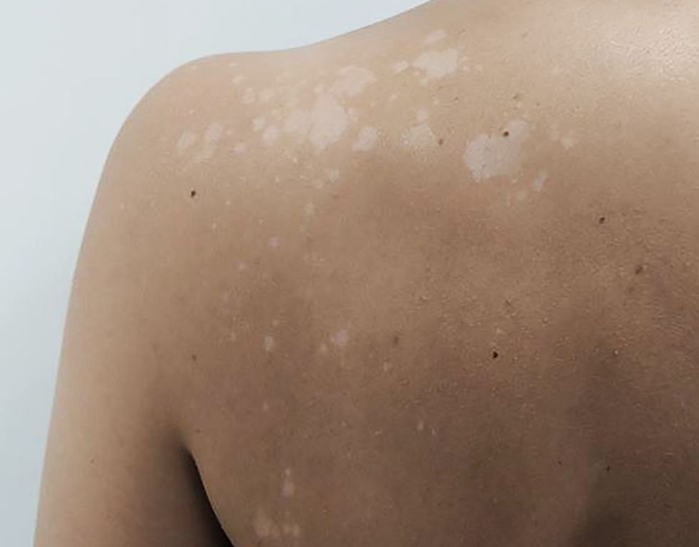 The skin condition tinea versicolor, also referred to as pityriasis versicolor, is prevalent and is caused by an overgrowth of yeast on the surface of the skin (Image via Cosmopolitan UK)