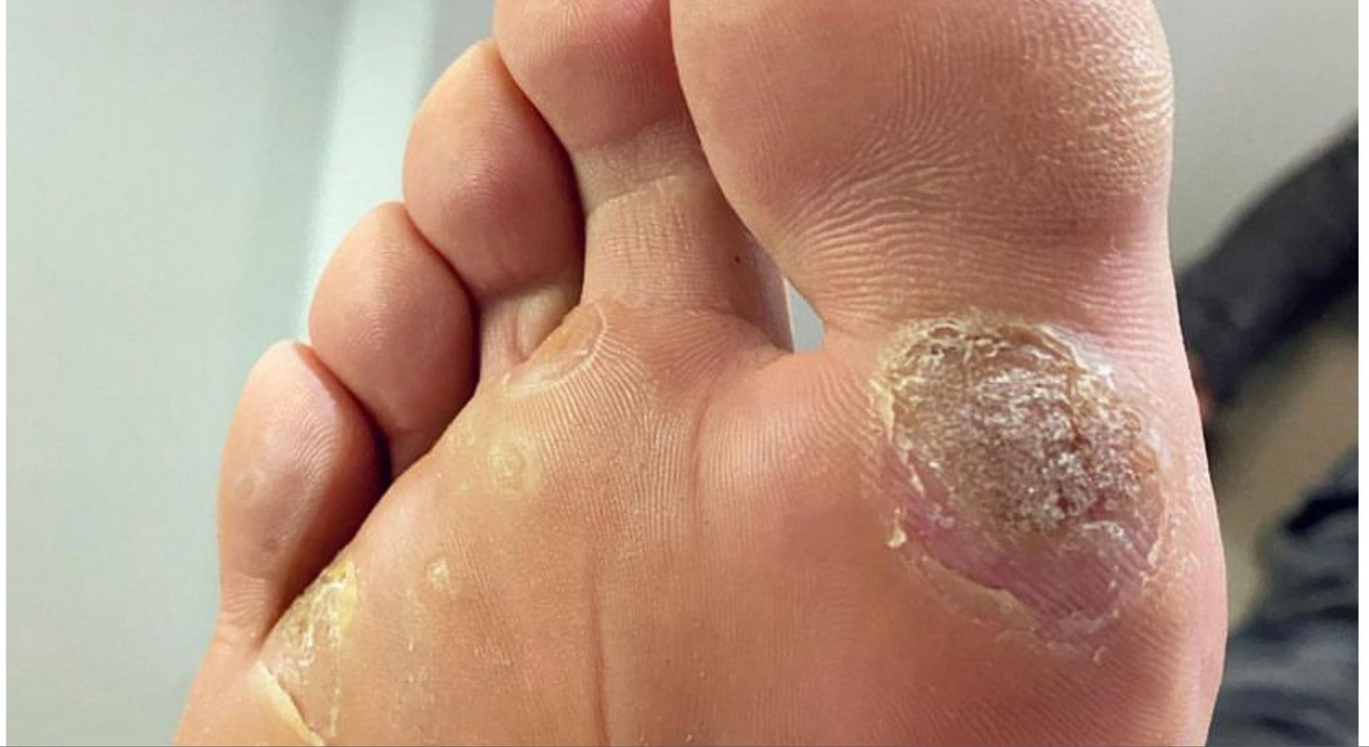 Warts on the feet can be treated by several methods. (Photo via Instagram/drmichaelcollins)