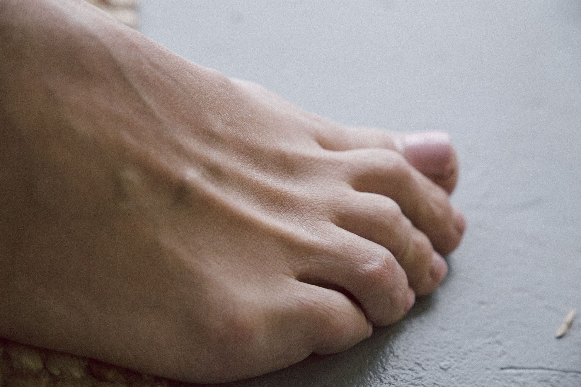 Symptoms of gout appear in the big toe frequently. (Image via Unsplash/ Klara Kulikova)